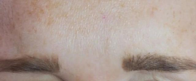 Botox after at River Aesthetics in Eagle, ID