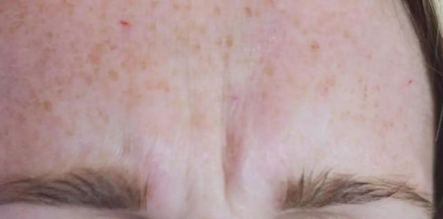 Botox before at River Aesthetics in Eagle, ID