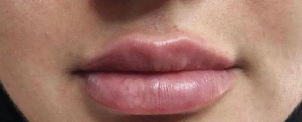 River Aesthetics lip filler after — Eagle, ID