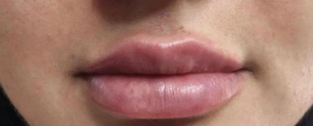 Juvederm after at River Aesthetics in Eagle, ID