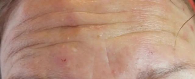 Botox before at River Aesthetics in Eagle, ID