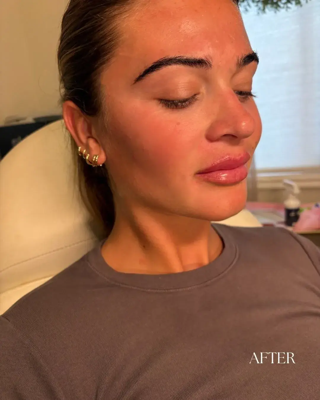 River Aesthetics lip filler after — Eagle, ID