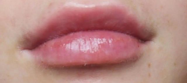 Juvederm after at River Aesthetics in Eagle, ID