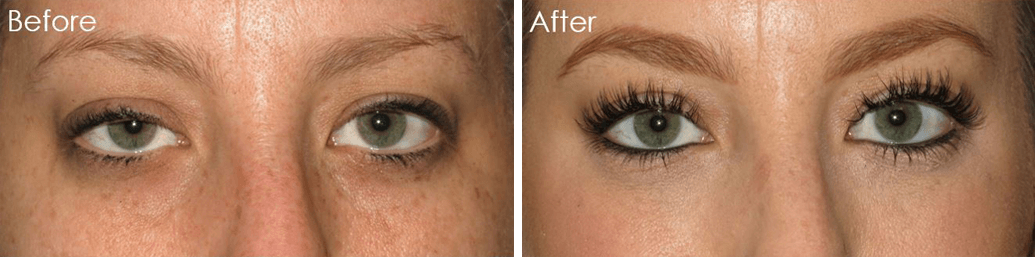 Yao Wang, MD - Irvine Oculoplastic Surgeon eyelid lift result — Irvine, CA