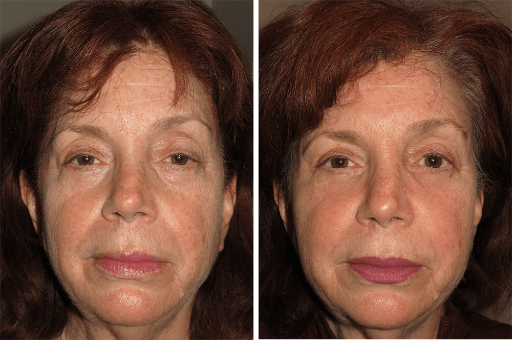 Yao Wang, MD - Irvine Oculoplastic Surgeon fat transfer result — Irvine, CA