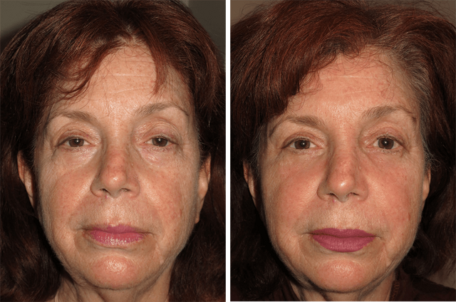 Fat Transfer result at Yao Wang, MD - Irvine Oculoplastic Surgeon in Irvine, CA