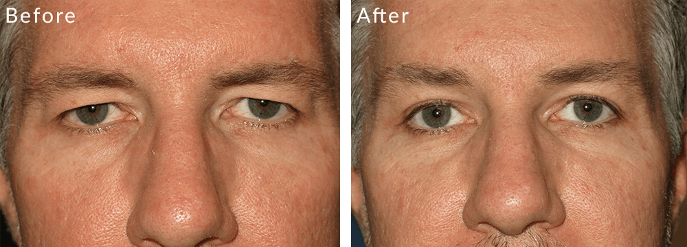 Yao Wang, MD - Irvine Oculoplastic Surgeon eyelid lift result — Irvine, CA