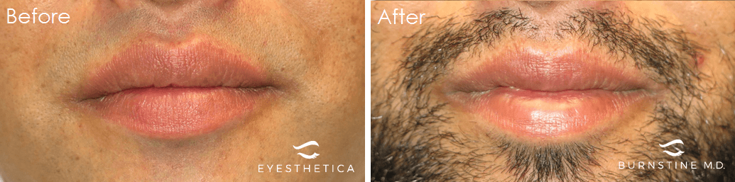 Yao Wang, MD - Irvine Oculoplastic Surgeon result — Irvine, CA