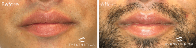 Lip Filler result at Yao Wang, MD - Irvine Oculoplastic Surgeon in Irvine, CA