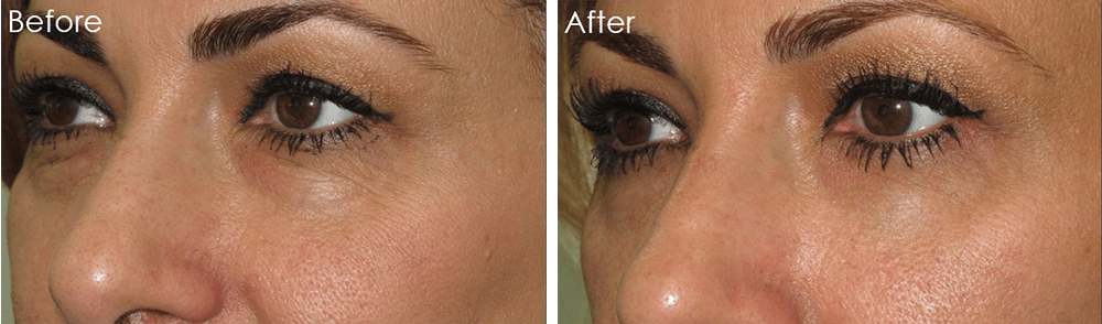 Yao Wang, MD - Irvine Oculoplastic Surgeon result — Irvine, CA