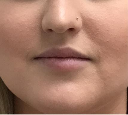 Lip Filler before at Skin Perfect Medical Aesthetics in Costa Mesa, CA