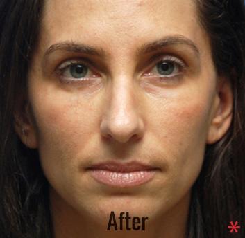 Blepharoplasty after at Skin Perfect Medical Aesthetics in Costa Mesa, CA