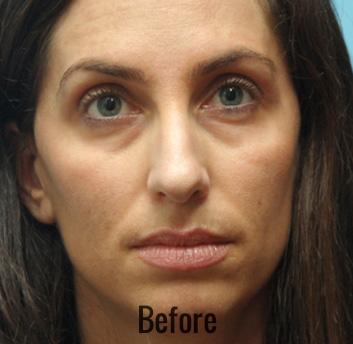 Blepharoplasty before at Skin Perfect Medical Aesthetics in Costa Mesa, CA