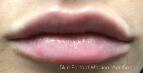 Lip Filler after at Skin Perfect Medical Aesthetics in Costa Mesa, CA