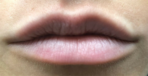 Lip Filler before at Skin Perfect Medical Aesthetics in Costa Mesa, CA