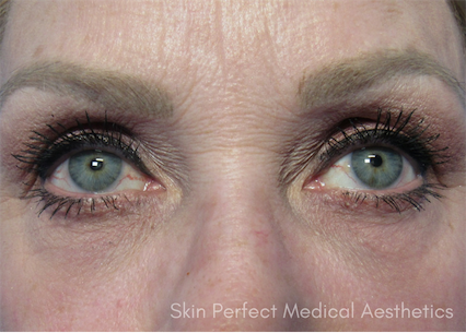 Blepharoplasty after at Skin Perfect Medical Aesthetics in Costa Mesa, CA
