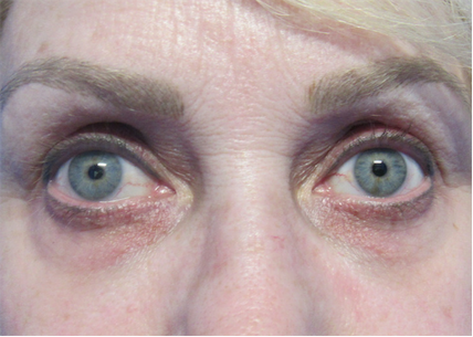 Blepharoplasty before at Skin Perfect Medical Aesthetics in Costa Mesa, CA