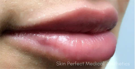 Lip Filler after at Skin Perfect Medical Aesthetics in Costa Mesa, CA