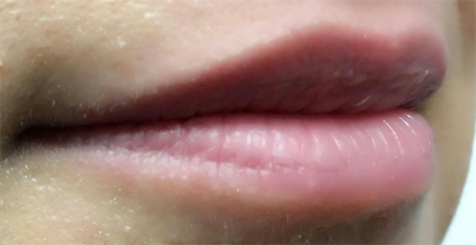 Lip Filler before at Skin Perfect Medical Aesthetics in Costa Mesa, CA
