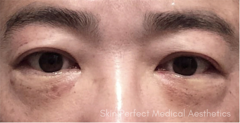 Blepharoplasty after at Skin Perfect Medical Aesthetics in Costa Mesa, CA