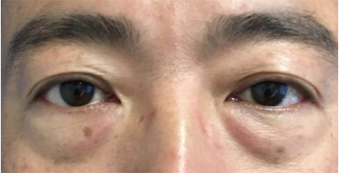 Blepharoplasty before at Skin Perfect Medical Aesthetics in Costa Mesa, CA