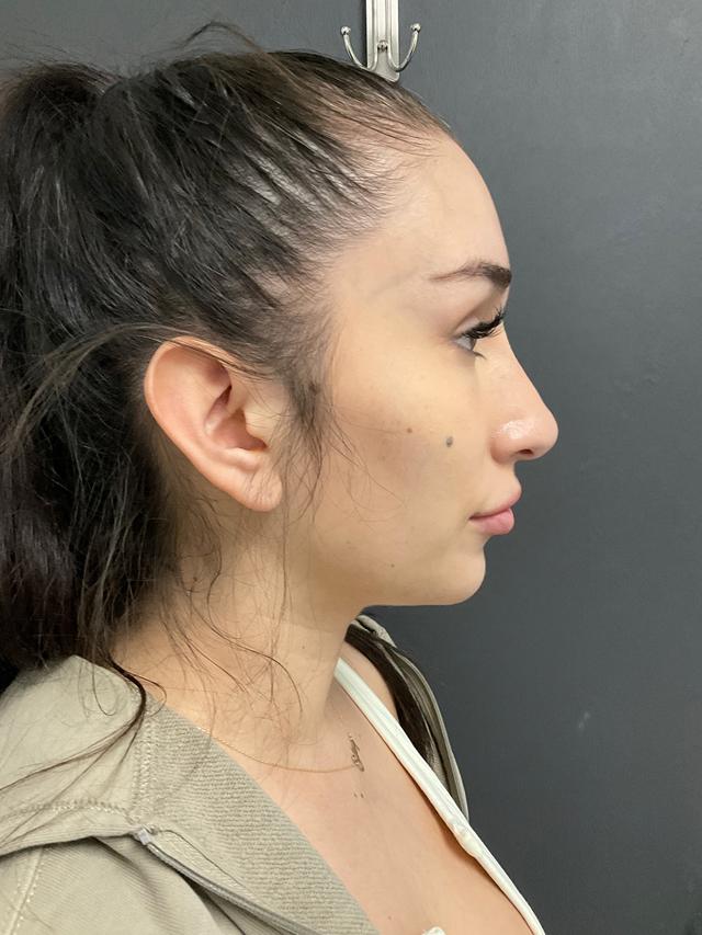 Rhinoplasty after at Skin Perfect Medical Aesthetics in Costa Mesa, CA