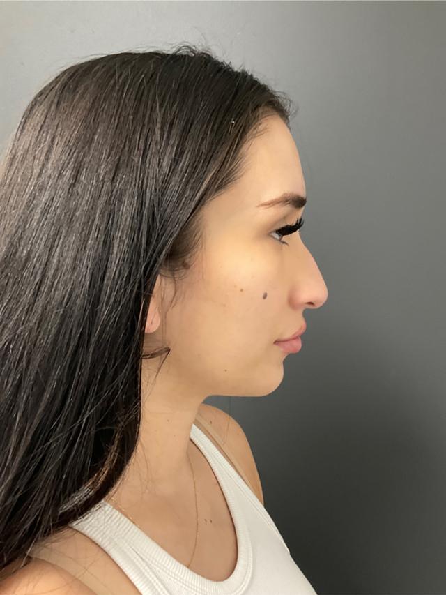 Rhinoplasty before at Skin Perfect Medical Aesthetics in Costa Mesa, CA
