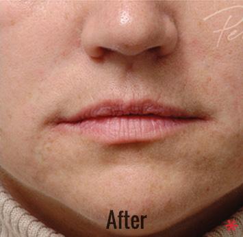 Lip Filler after at Skin Perfect Medical Aesthetics in Costa Mesa, CA
