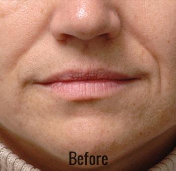 Lip Filler before at Skin Perfect Medical Aesthetics in Costa Mesa, CA
