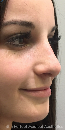 Rhinoplasty after at Skin Perfect Medical Aesthetics in Costa Mesa, CA