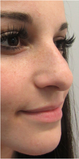 Rhinoplasty before at Skin Perfect Medical Aesthetics in Costa Mesa, CA