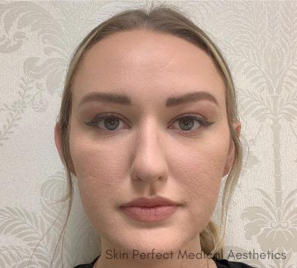 Juvederm after at Skin Perfect Medical Aesthetics in Costa Mesa, CA