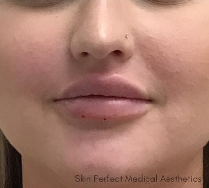 Lip Filler after at Skin Perfect Medical Aesthetics in Costa Mesa, CA