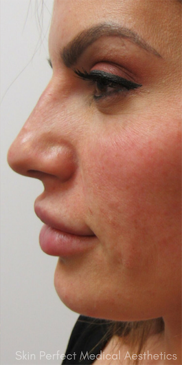 Functional Rhinoplasty after at Skin Perfect Medical Aesthetics in Costa Mesa, CA