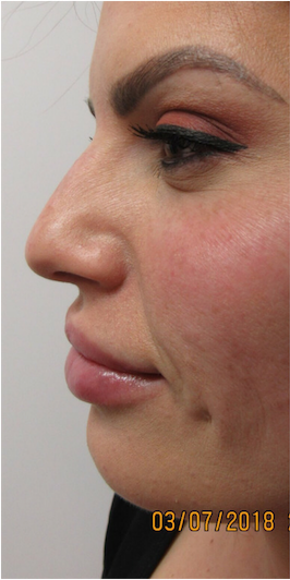 Functional Rhinoplasty before at Skin Perfect Medical Aesthetics in Costa Mesa, CA