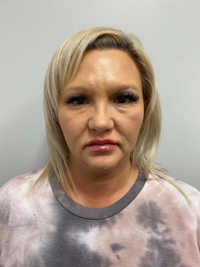 Lip Filler after at Skin Perfect Medical Aesthetics in Costa Mesa, CA