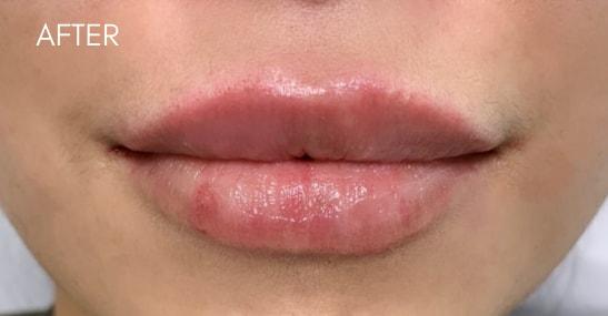 Skin Perfect Medical Aesthetics lip filler after — Costa Mesa, CA