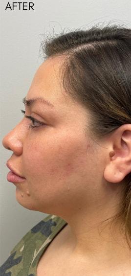 Jawline Filler after at Skin Perfect Medical Aesthetics in Costa Mesa, CA