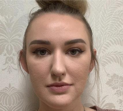 Juvederm before at Skin Perfect Medical Aesthetics in Costa Mesa, CA