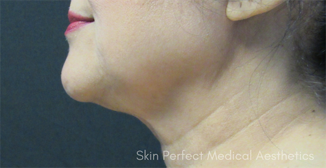 Neck Liposuction after at Skin Perfect Medical Aesthetics in Costa Mesa, CA