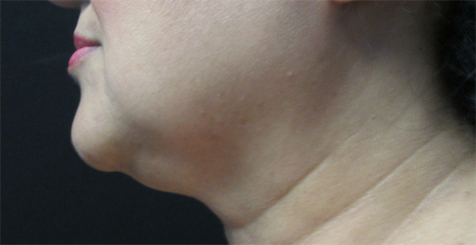 Neck Liposuction before at Skin Perfect Medical Aesthetics in Costa Mesa, CA
