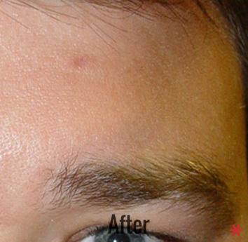Skin Perfect Medical Aesthetics after — Costa Mesa, CA