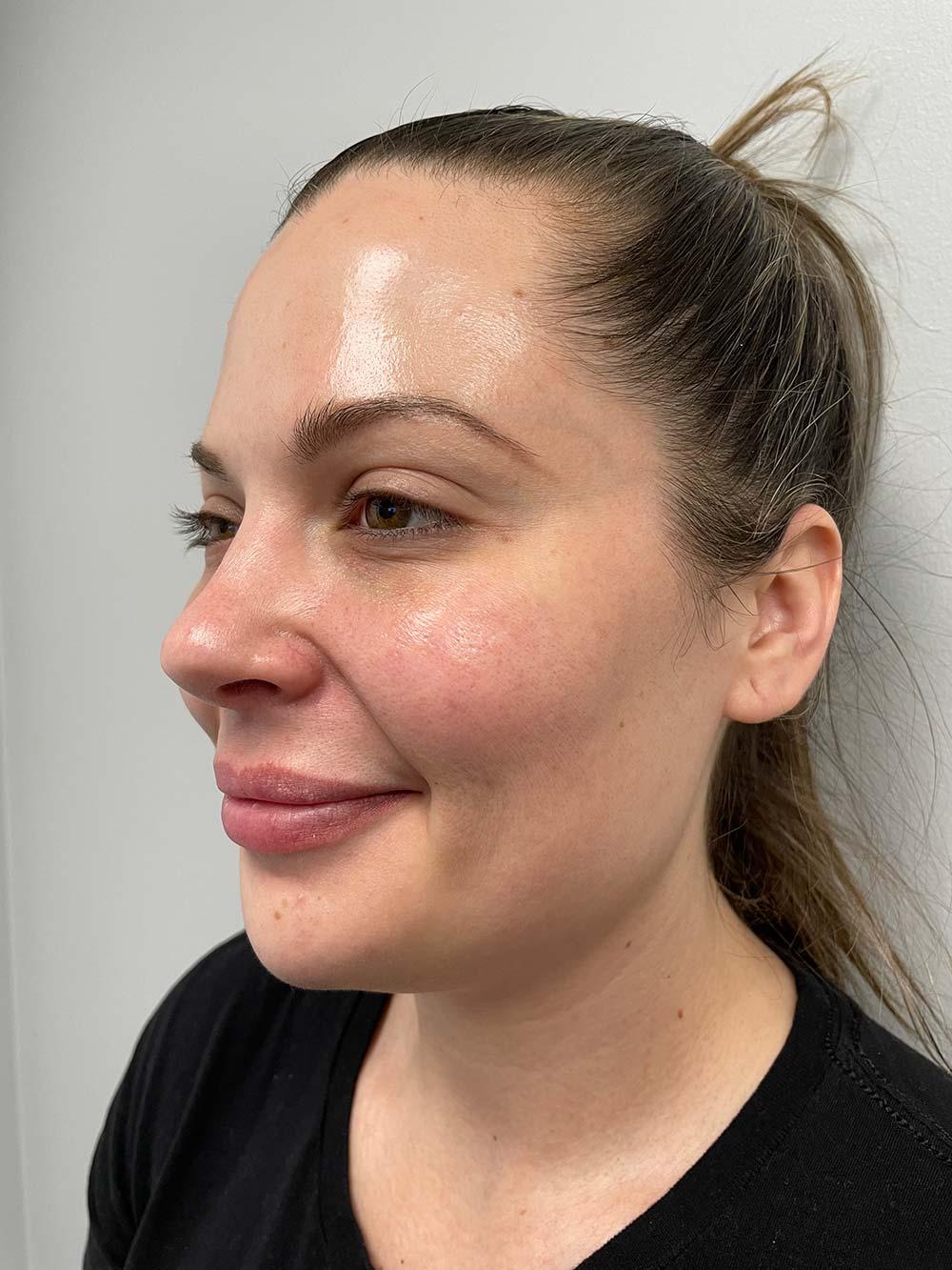 Skin Perfect Medical Aesthetics botox after — Costa Mesa, CA