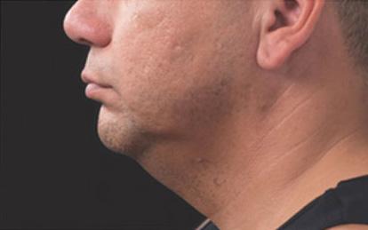Neck Liposuction after at Skin Perfect Medical Aesthetics in Costa Mesa, CA