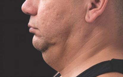Neck Liposuction before at Skin Perfect Medical Aesthetics in Costa Mesa, CA
