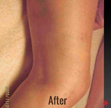 Skin Perfect Medical Aesthetics after — Costa Mesa, CA