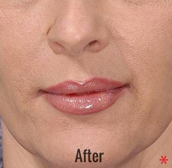 Lip Filler after at Skin Perfect Medical Aesthetics in Costa Mesa, CA