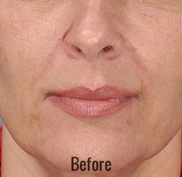 Lip Filler before at Skin Perfect Medical Aesthetics in Costa Mesa, CA