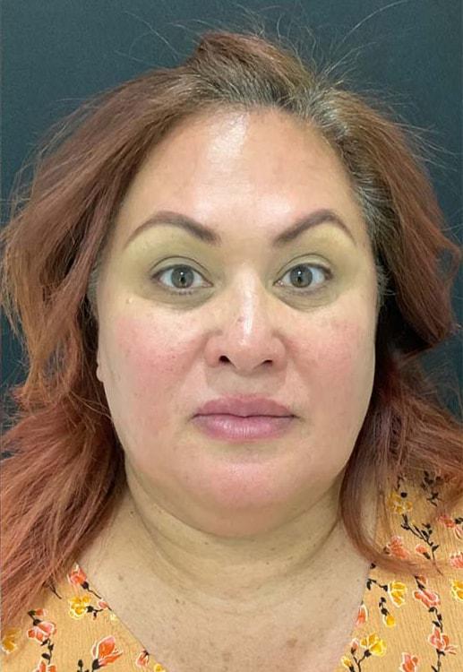 Skin Perfect Medical Aesthetics botox after — Costa Mesa, CA