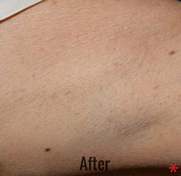 Skin Perfect Medical Aesthetics after — Costa Mesa, CA